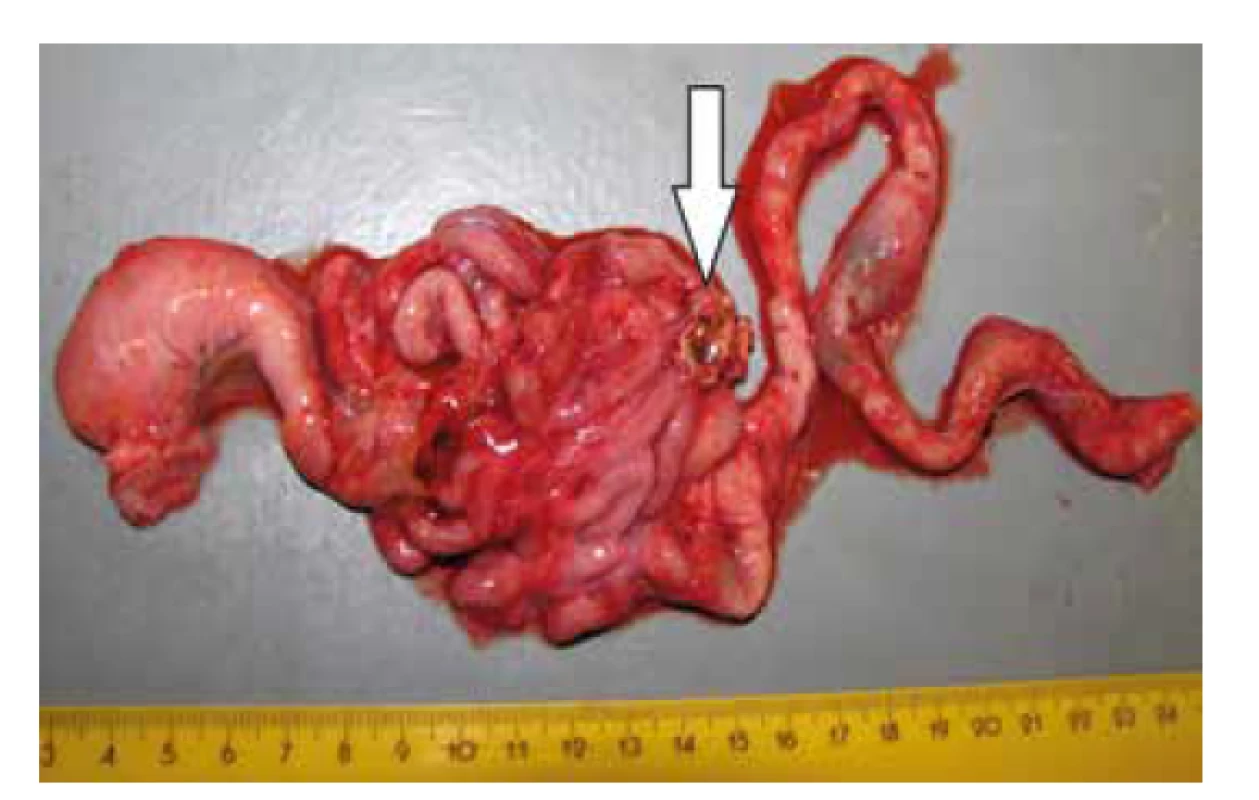 Vypreparovaný gastrointestinálny trakt s s tumoriformným útvarom
v oblasti ilea (šípka).