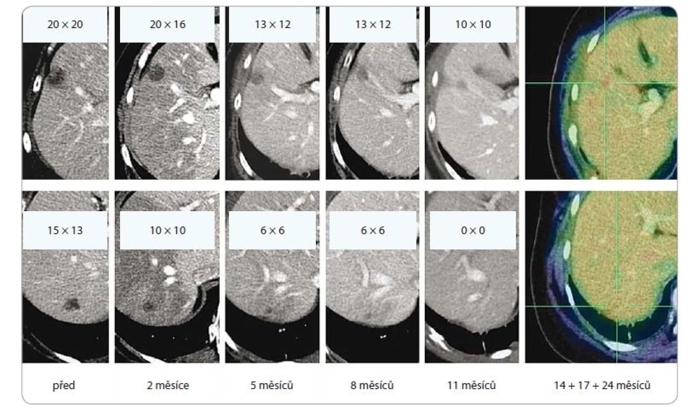 Efekt ozáření dvou jaterních metastáz lobulárního karcinomu levého prsu, dávka 3 × 18 Gy, předpis do mediánu dávky v PTV
(PTV 51,7 ccm, D min. 48,7 Gy, D max. 56,6 Gy). Patrná postupná regrese obou ložisek, vznik a ústup postradiační reakce v jaterním
parenchymu. Poslední obrázek v řadě ilustruje stacionární nález ve 14., 17. a 24. měsíci sledování.<br>
PTV – plánovací cílový objem, D – dávka záření, Gy – Gray