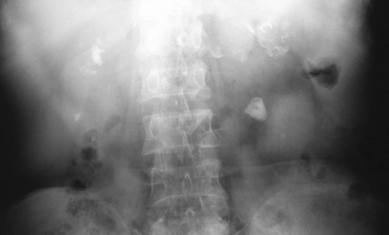 Nativní nefrogram: TB
kalcifikace obou ledvin<br>
Fig. 5. Plain x-ray KUB: TB calcifications
in both kidneys