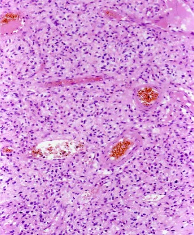Světlobuněčný renální karcinom u pacienta
s VHL syndromem. Barveno HE. Zvětšeno 400×<br>
Fig. 5. Clear cell renal cell carcinoma, patient with a VHL
syndrome. H&E. Viewed at 400× magnification