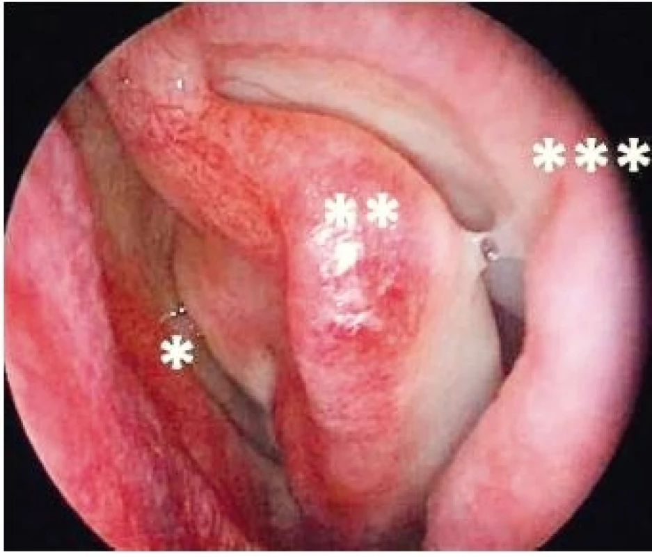 Endoskopický pohled do nosní dutiny vlevo. Je patrné
kompenzatorní rozšíření středního nosního průchodu (*), vpáčení
střední skořepy (**), lateralizace bočn