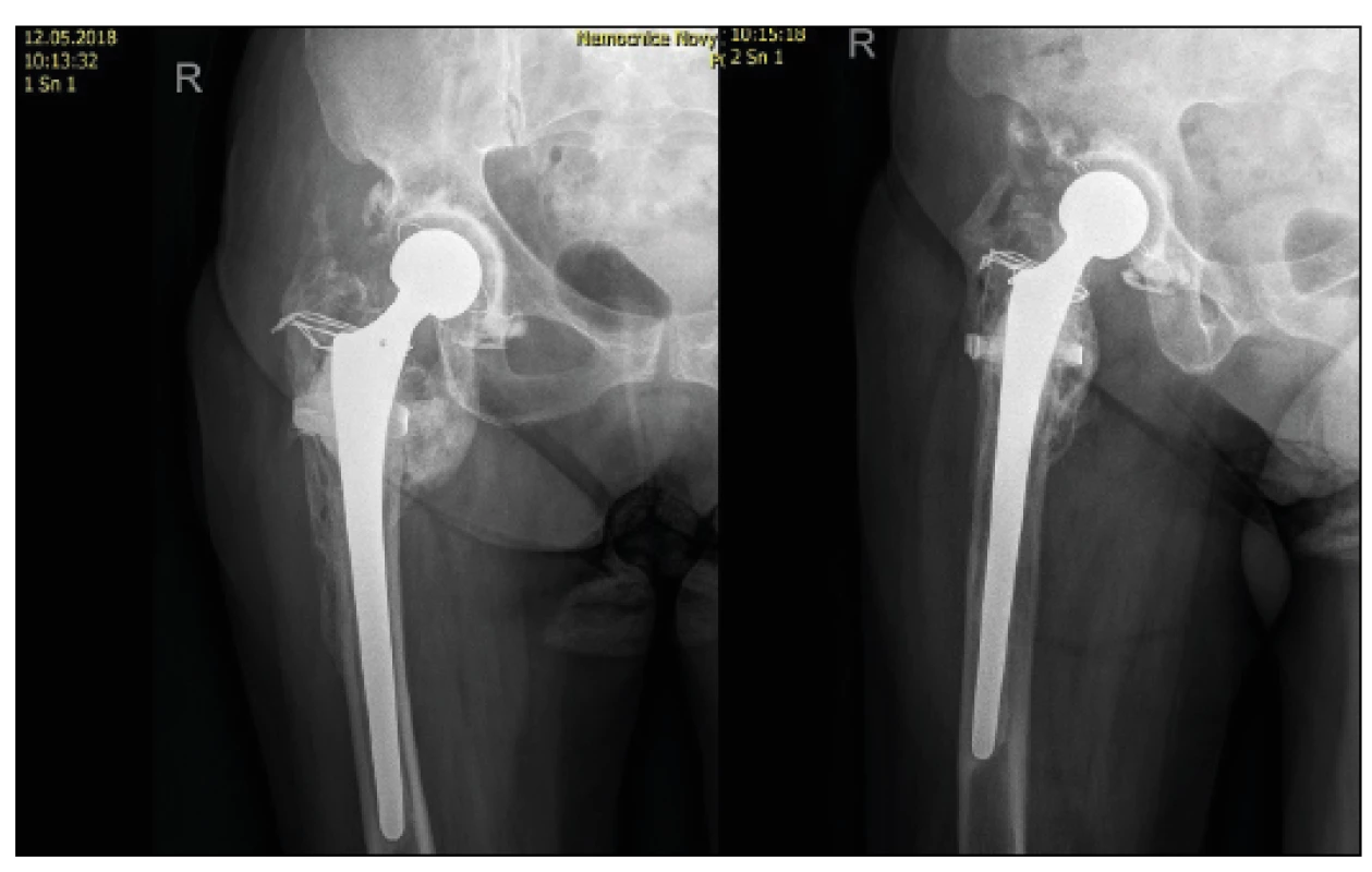 70letá žena s tříštivou zlomeninou trochanterického masivu a
nekrózou hlavice femuru, kontrolní RTG po implantaci TEP s dříkem
Centrament