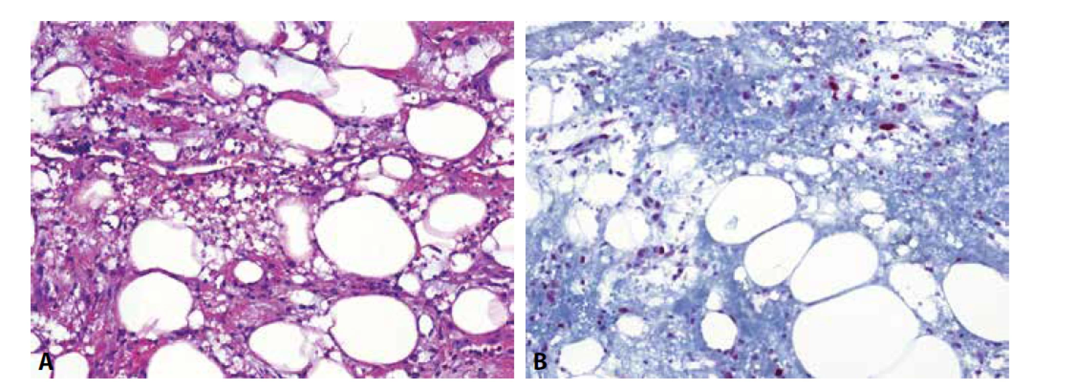 Traumatizovaná tuková tkáň (A) je jednou z lézí, která poměrně věrně napodobuje atypický lipomatózní tumor/dobře diferencovaný liposarkom.
Situaci dále komplikuje exprese MDM2 proteinu v nenádorových endoteliích a obzvláště v makrofázích, kterých je zde značné množství (B).