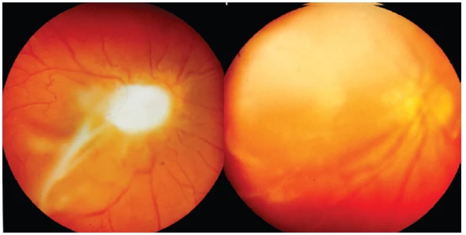 Left: Toxocara granuloma lying above the optic nerve papilla and macular region with preretinal membranous structures and vitritis
Right: Extensive whitish toxocara granuloma extending from the macular area into the upper central periphery of retina with vitritis

