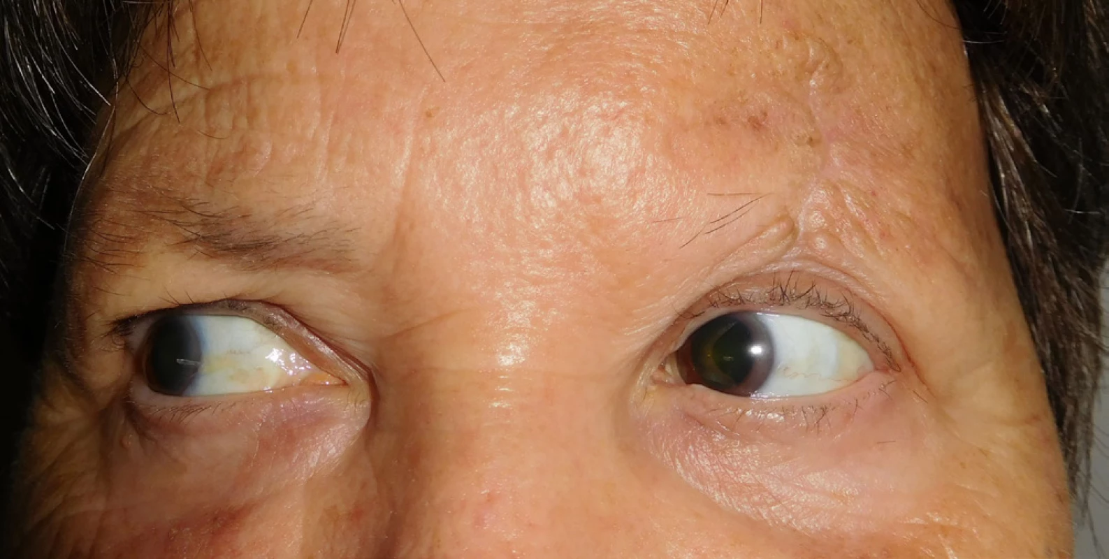 Patient 2 – detail of scar of upper eyelid with no recurrence
of MCC in September 2017