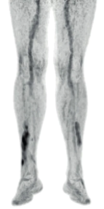 PET/CT zobrazení dolních končetin s vyznačeným
xantogranulomem z roku 2017