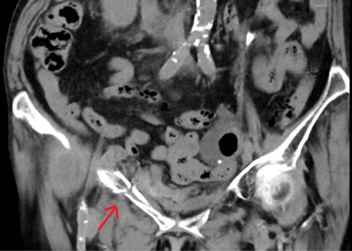 Nativní CT koronární
řez, šipka ukazuje frakturu
horního raménka stydké kosti
vpravo<br>
Fig. 1. Non contrast CT coronal
section, the arrow shows
the fracture of the right superior
pubic rumus
