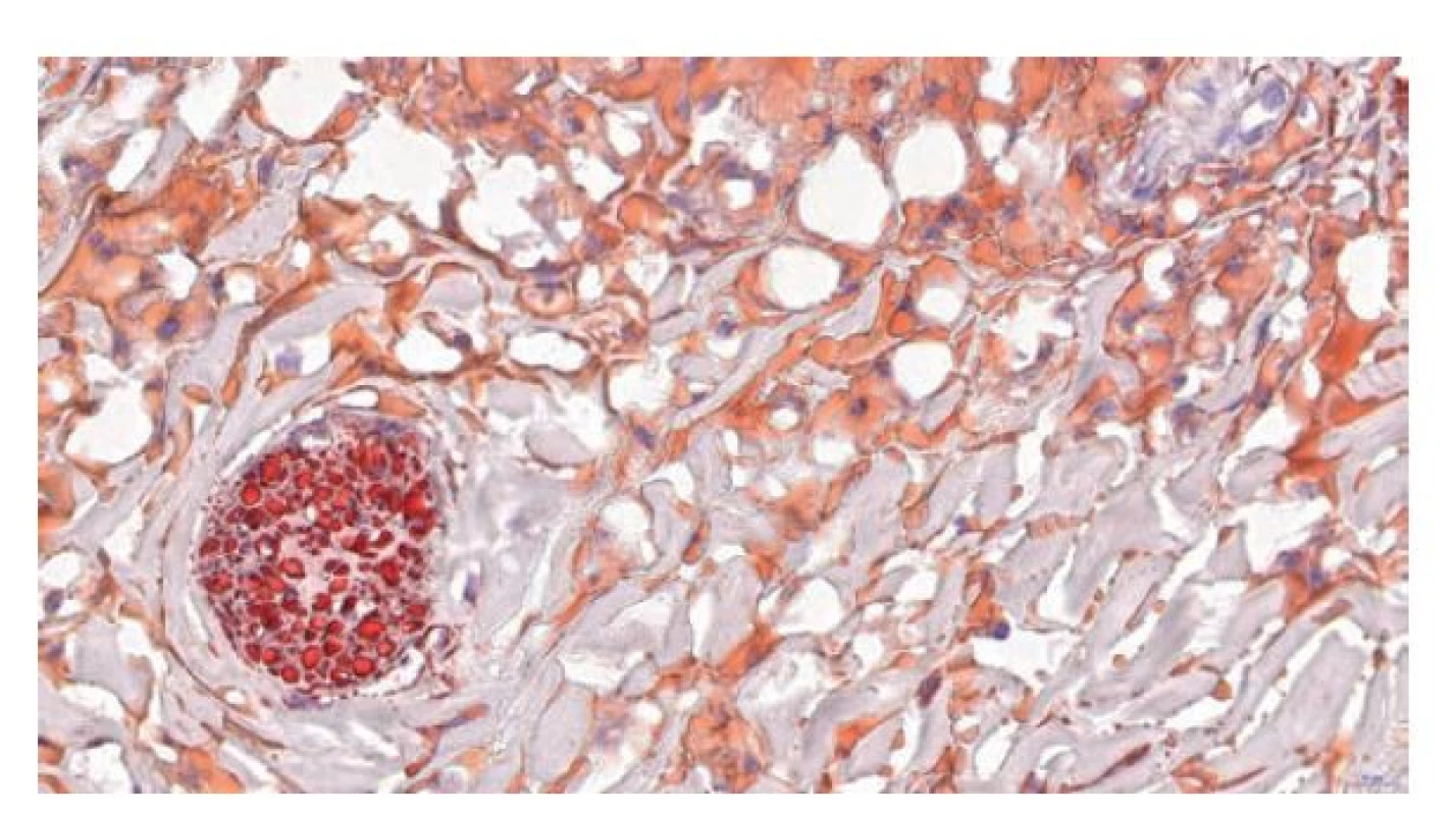 Histologie zmraženého řezu obarveného olejovou červení, která
vykazuje silnou afinitu k myelinovým pochvám periferního nervu a slabší
afinitu k lipidovému materiálu uvnitř makrofágů, 49.3x.