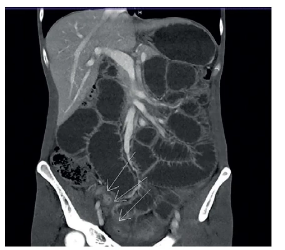 Koronální CT řez − rozsah stenózy a zánětu terminálního
ilea<br>
Fig. 2: Coronal CT section − extent of the stenosis and inflammation
of the terminal ileum