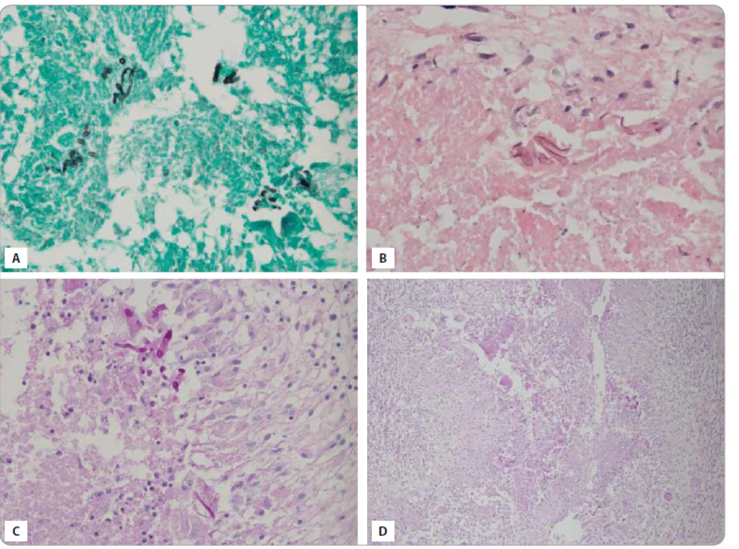 Mikroskopický nález hýf mukoru vo vyšetrenom tkanive z CNS – granulomatózny, nekrotizujúci zápal CNS s mykotickými
organizmami.<br>
A. Grocottove farbenie 40×.
B. Hematoxylín-eozín 40×.
C. PAS 40×.
D. PAS 10×.
(Ústav patologickej anatómie, JLF UK a UN Martin, 2018)
CNS – centrálna nervová sústava, PAS – periodic acid schiff