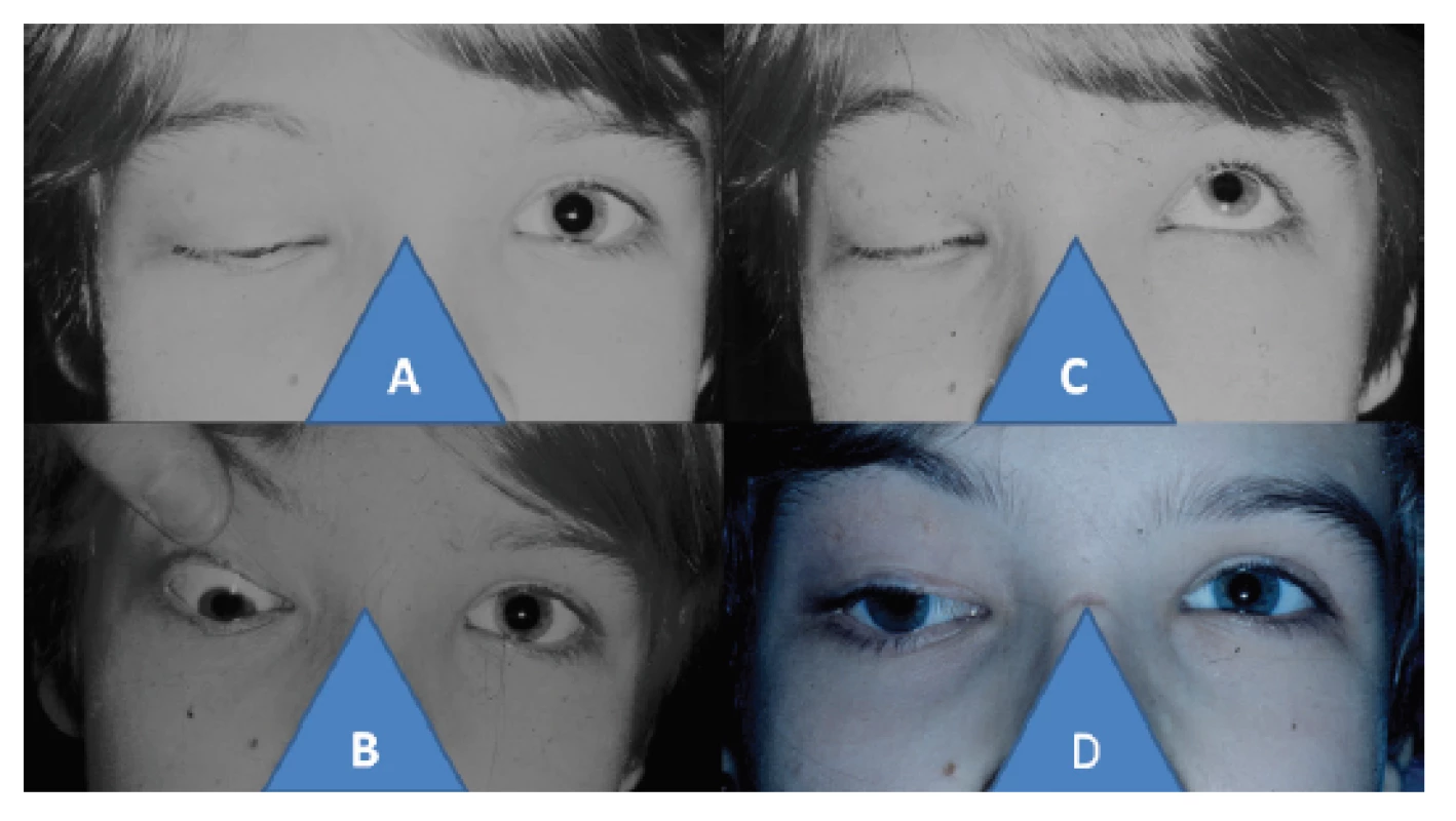 11-letá dívka s pravostranným syndromem kongenitální
fibrózy: uzavřena oční štěrbina vpravo (A), hypotropie vpravo při
pasivním otevření oční štěrbiny (B), nulová schopnost otevření
oční štěrbiny vpravo při snaze o elevaci (C), postavení horního
víčka a bulbu vpravo po čtyřech letech od komplexního trojnásobného
operačního postupu podle cul-de-sac, podle Knappa, podle
Foxe (D)