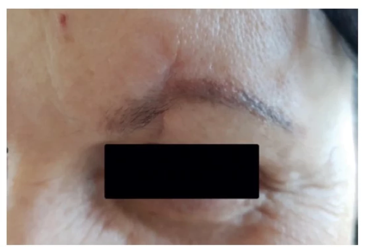 Stav 2 měsíce po chirurgické korekci jizvy<br>
Fig. 4: Condition two months after surgical revision of the
scar