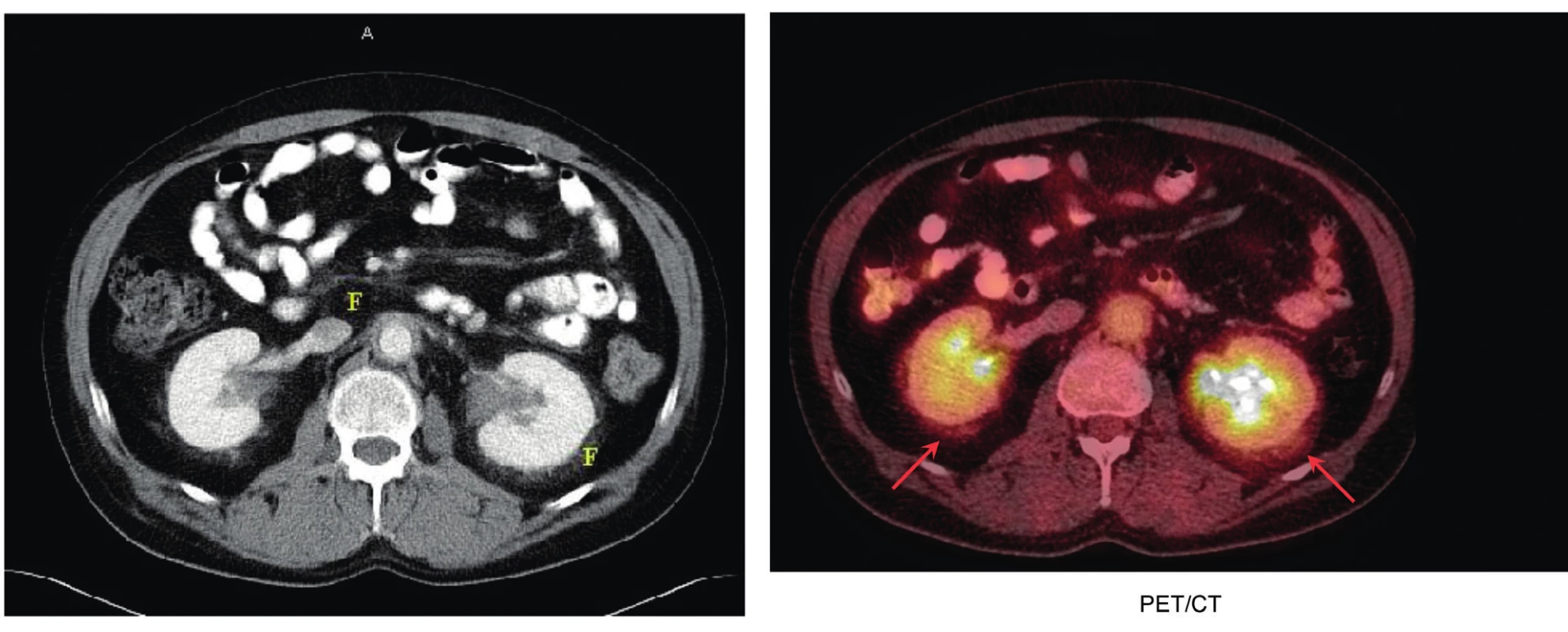 Erdheimova-Chesterova nemoc způsobuje fibrotizaci v oblasti retroperitonea, zejména perirenálně<br>
Vlevo na klasickém CT snímku jsou místa s fibrotickými změnami označena písmenem F, vpravo na FDG-PET/CT zobrazení jsou místa perirenální
fibrózy označená šipkami. Perirenální fibróza je pro Erdheimovu-Chesterovu chorobu typická.