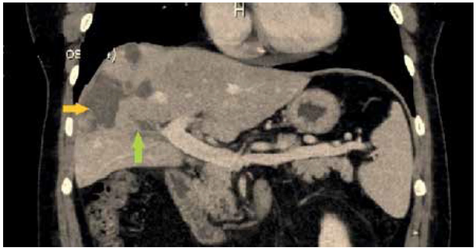 CT obraz s obliterovanou portální větví pro segment V a VIII (zelená šipka), hypoperfuzní
změny v okolí (žlutá šipka)<br>
Fig. 3. CT scan with occluded portal branch for segments V and VIII (green arrow), surrounded
with hypoperfusion of the liver parenchyma (yellow arrow)