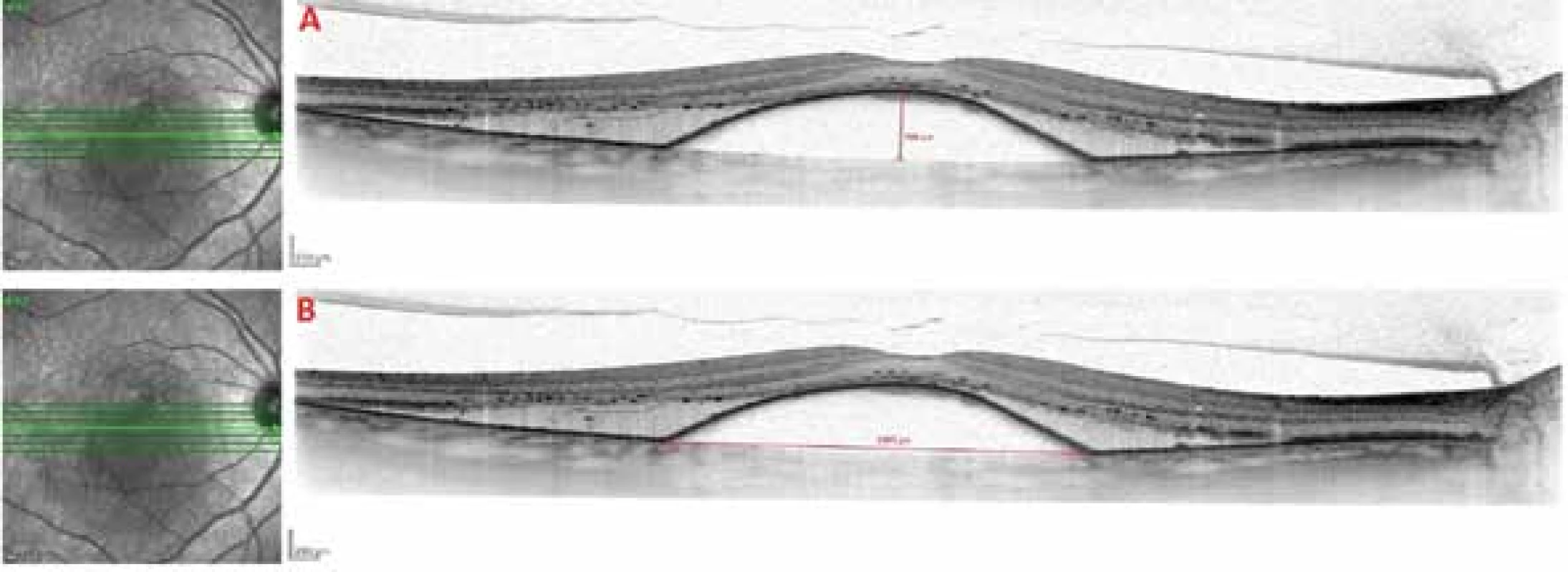  SD-OCT snímek vaskulární serózní ablace retinálního pigmentového epitelu na podkladě
okultní choroidální neovaskularizace
A. Metodika měření výšky ablace retinálního pigmentového epitelu
B. Metodika měření šířky ablace retinálního pigmentového epitelu