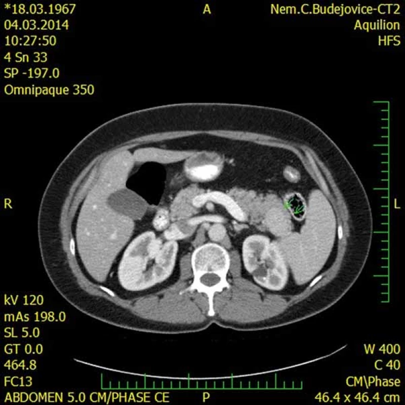 CT s nálezem intrapankreaticky uložené akcesorní sleziny (IPAS) (šipky).
Fig. 3. A CT scan showing an intrapancreatic accessory spleen (IPAS) (arrows).