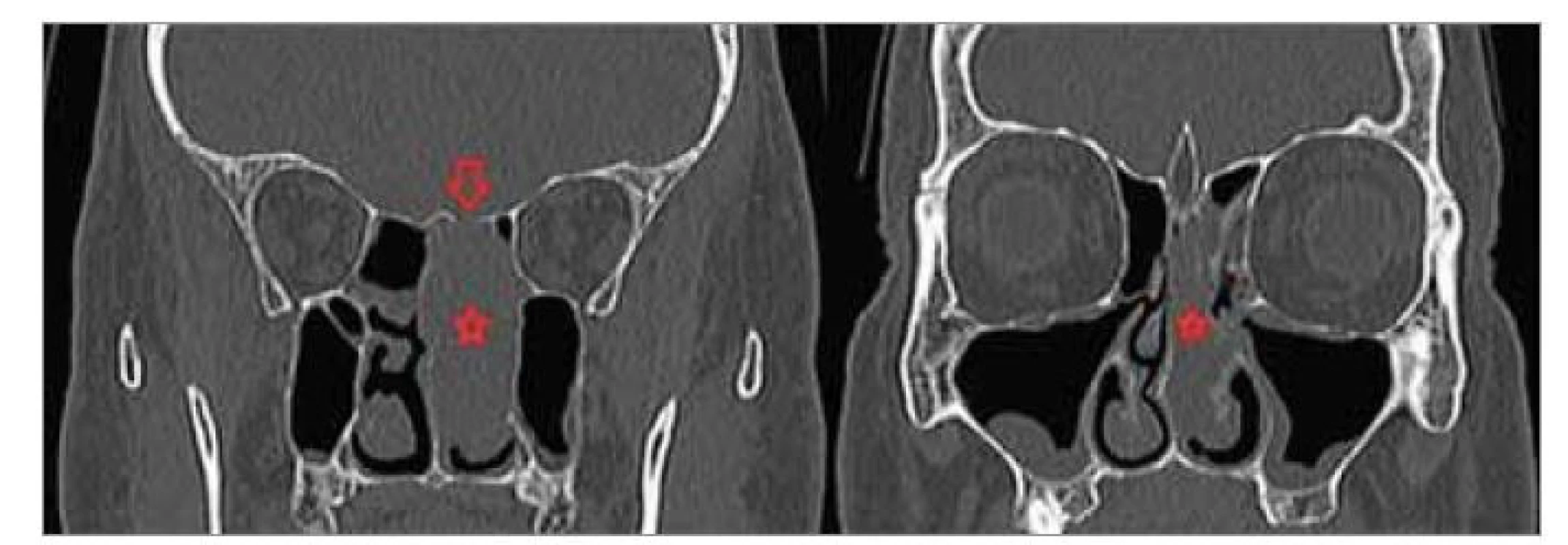 Předoperační CT VND, koronární projekce.<br>
Hvězdička – nádor, šipka – místo kostní eroze rinobáze.<br>
Fig. 1. Preoperative CT VND, coronary projection.<br>
Star – tumour, arrow – site of rhinobase bone erosion.