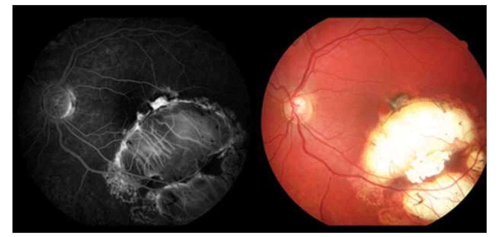 Kontrolné fluoroangiografické vyšetrenie a fotografia očného pozadia (2020)