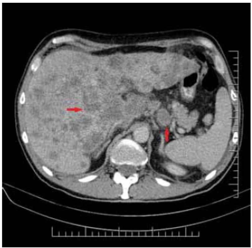 Tumour of pylorus – asymetric
thickening of the wall – coronary
projection.<br>
Obr. 4. Tumor pyloru – asymetrické
zhrubnutie steny – koronárna projekcia.
