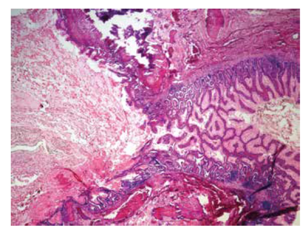 Ileum a stena Meckelovho divertikula vystlaná epitelom tenkého
čreva (hematoxylín-eozín, zväčšenie 40x).