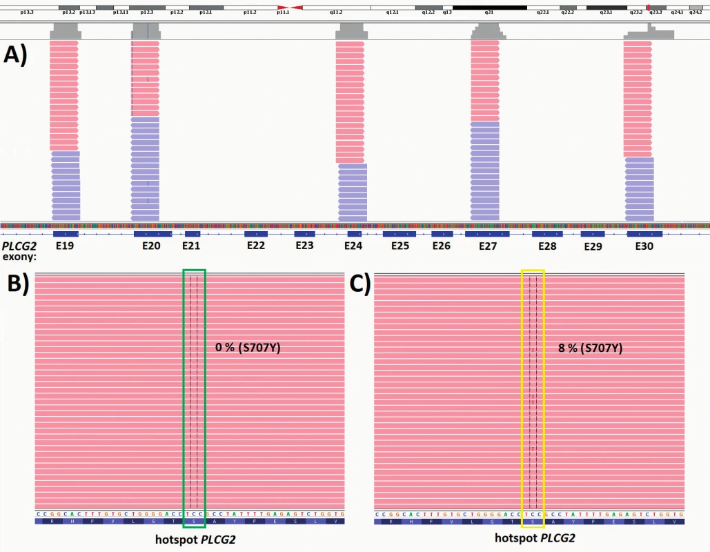 Výsledek NGS analýzy mutací v PLCG2 genu asociovaných s rezistencí u CLL pacienta léčeného ibritinibem. (A) Schematické znázornění sekvenované oblasti a pokrytí genu PLCG2: hotspot oblasti v exonech 19, 20, 24, 27 a 30. (B) Negativní odběr z doby před zahájením léčby. (C) Pozitivní odběr z doby 7 měsíců po zahájení léčby ibrutinibem.