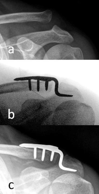 Muž, 38 let, AC luxace typu Rockwood III po pádu při jízdě na cyklistickém kole a) úrazové snímky, b) rentgenový nález na operačním sále po stabilizaci hákovou dlahou, c) stav ve třech měsících po operaci: zhojeno v anatomickém postavení v AC skloubení