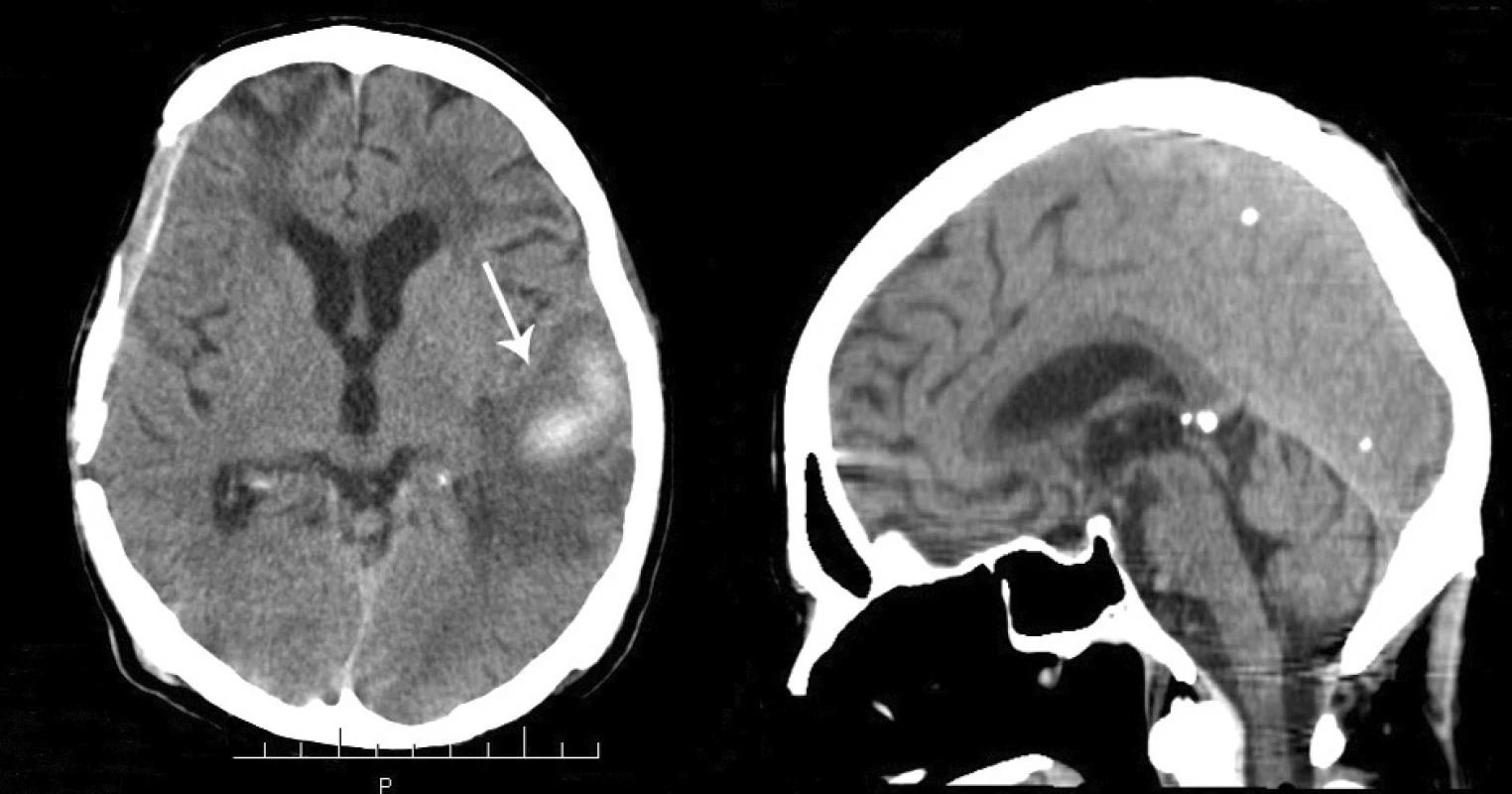 A – resolution of the previously observed contusion and hematoma
of the left temporal lobe. B – CT scan (sagittal section), diffuse cerebral and
cerebellar atrophy, complete resolution of the previously observed subdural
hematoma in the posterior fossa.