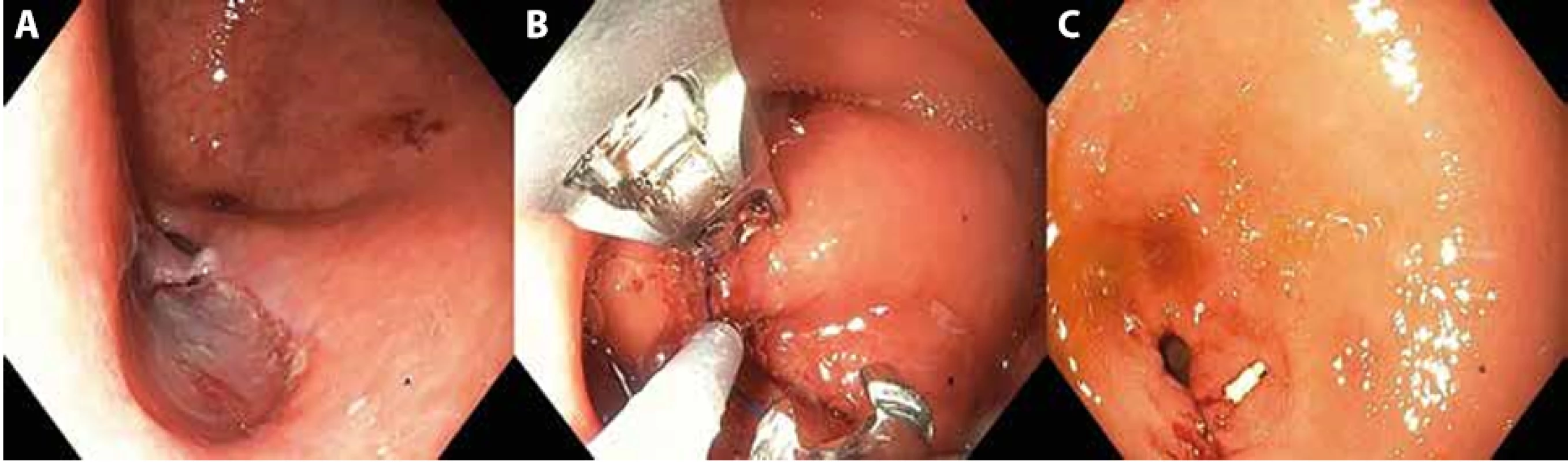 A) Endoscopic view of the longitudinal mucosal incision; B) Endoscopic suturing system used for mucosotomy closure; C) Successful closure.