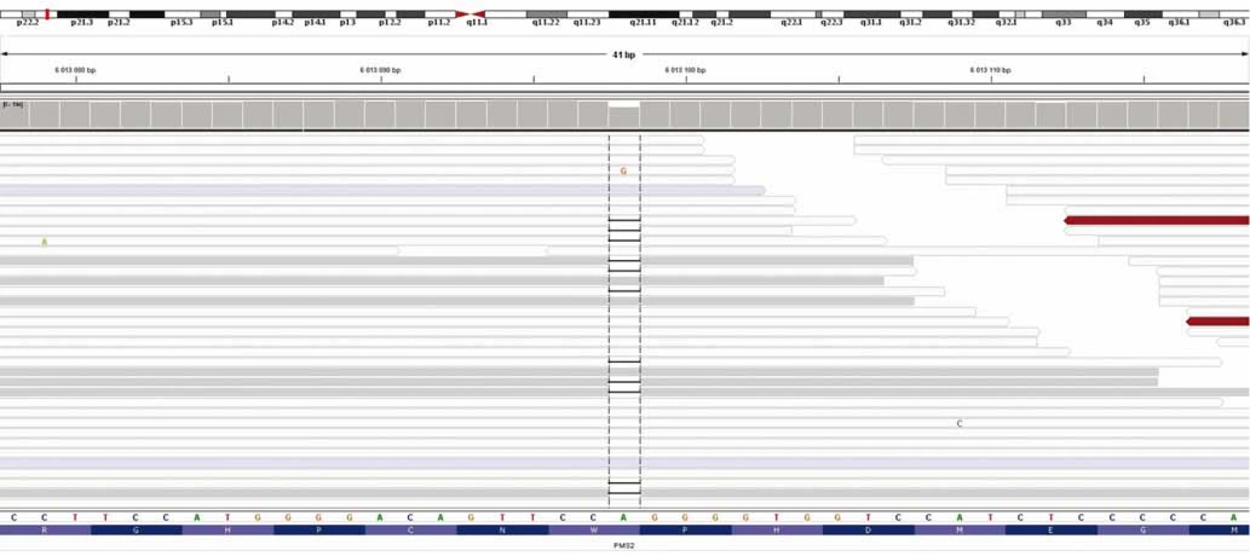 Výsledek celoexomového sekvenování – průkaz c.2521delT/p.W841fs genu PMS2.