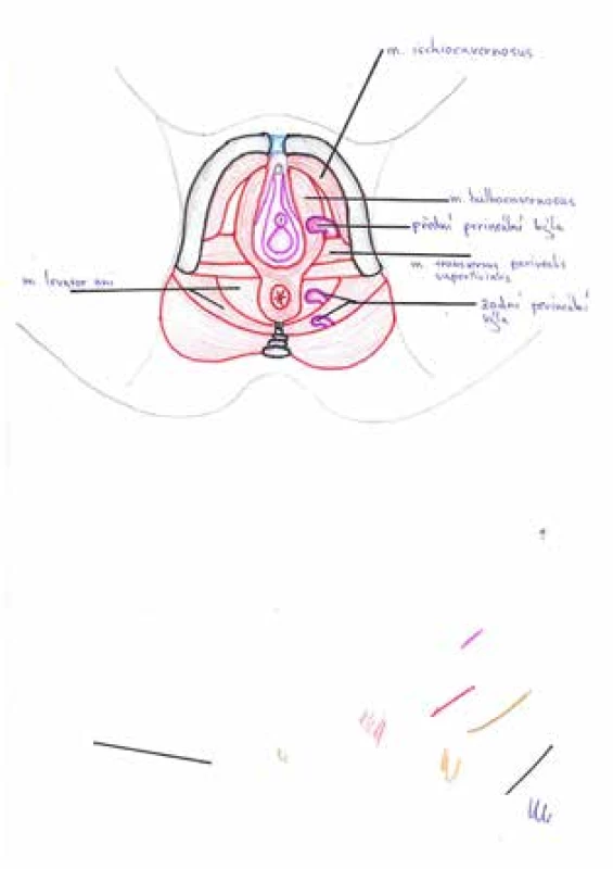 Pozice perineálních kýl vzhledem ke svalům pánevního dna, pacientka v litotomické poloze<br>
Fig. 4: Position of perineal hernia in pelvic floor; patient in
the lithotomy position