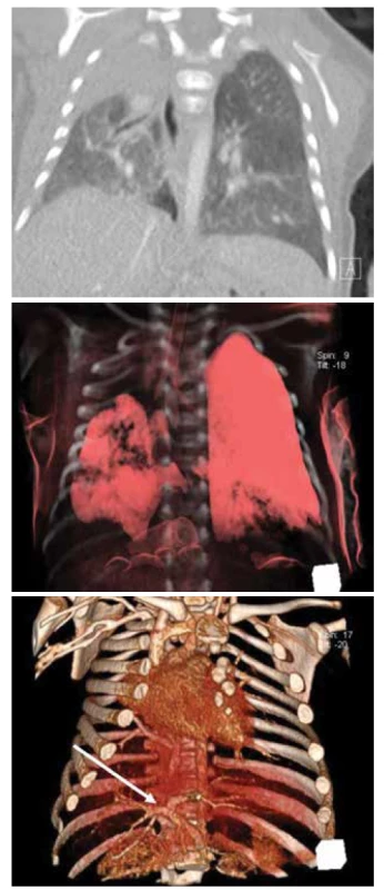 A. CT hrudníku, koronární řez, hypoplastická pravá plíce
s vadou sekvestračního spektra s projevy tachydyspnoe
při virovém respiračním infektu.<br>
Fig. 5A. Chest CT scan, coronary cut, hypoplastic right lung
with pulmonary sequestration. An infant with tachydyspnea
by having a common flu.<br>
Obr. 5B. CT hrudníku, 3D rekonstrukce.<br>
Fig. 5B. Chest CT scan, 3D reconstruction.<br>
Obr. 5C. CT plic, angiografie, 3D rekonstrukce, systémové
cévní zásobení pravé plíce.<br>
Fig. 5C. CT of the lungs, angiography, 3D reconstruction, systemic
vessel´s supply of the right lung.