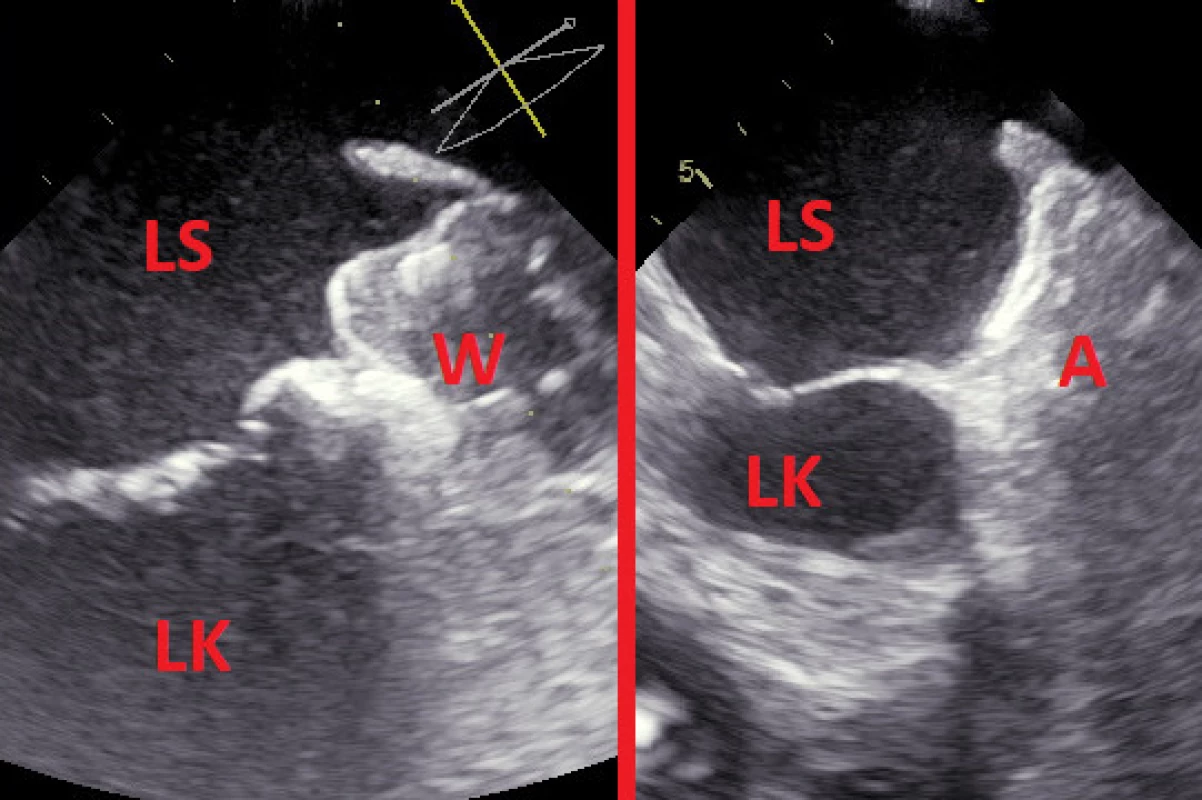 Nález z transezofageální echokardiografie 3 měsíce po úspěšném uzávěru ouška (vlevo okludérem Watchman, vpravo okludérem Amulet) 