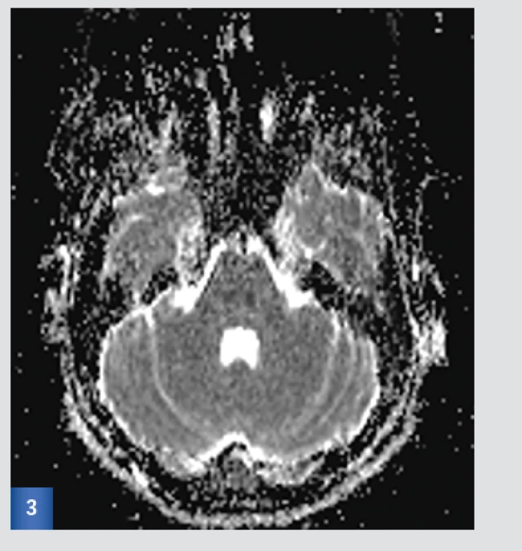 Vstupní MRI: ADC mapa