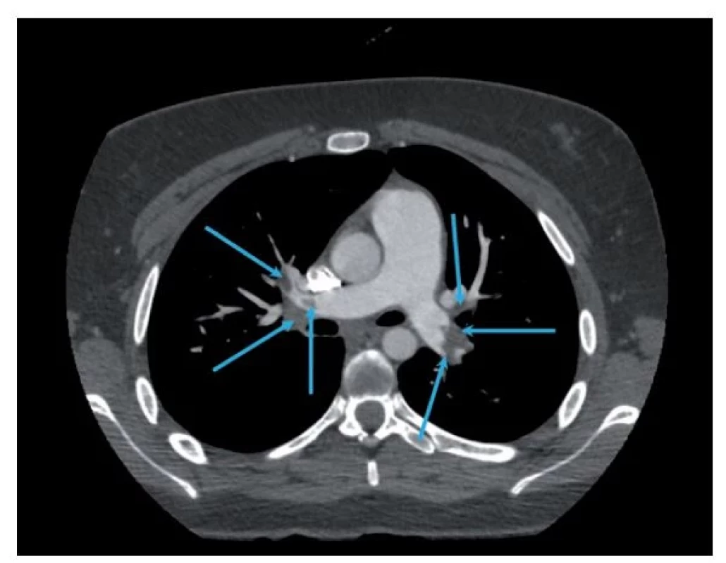 CT angiografie plicnice, plicní embolie oboustranně – defekty
v náplni