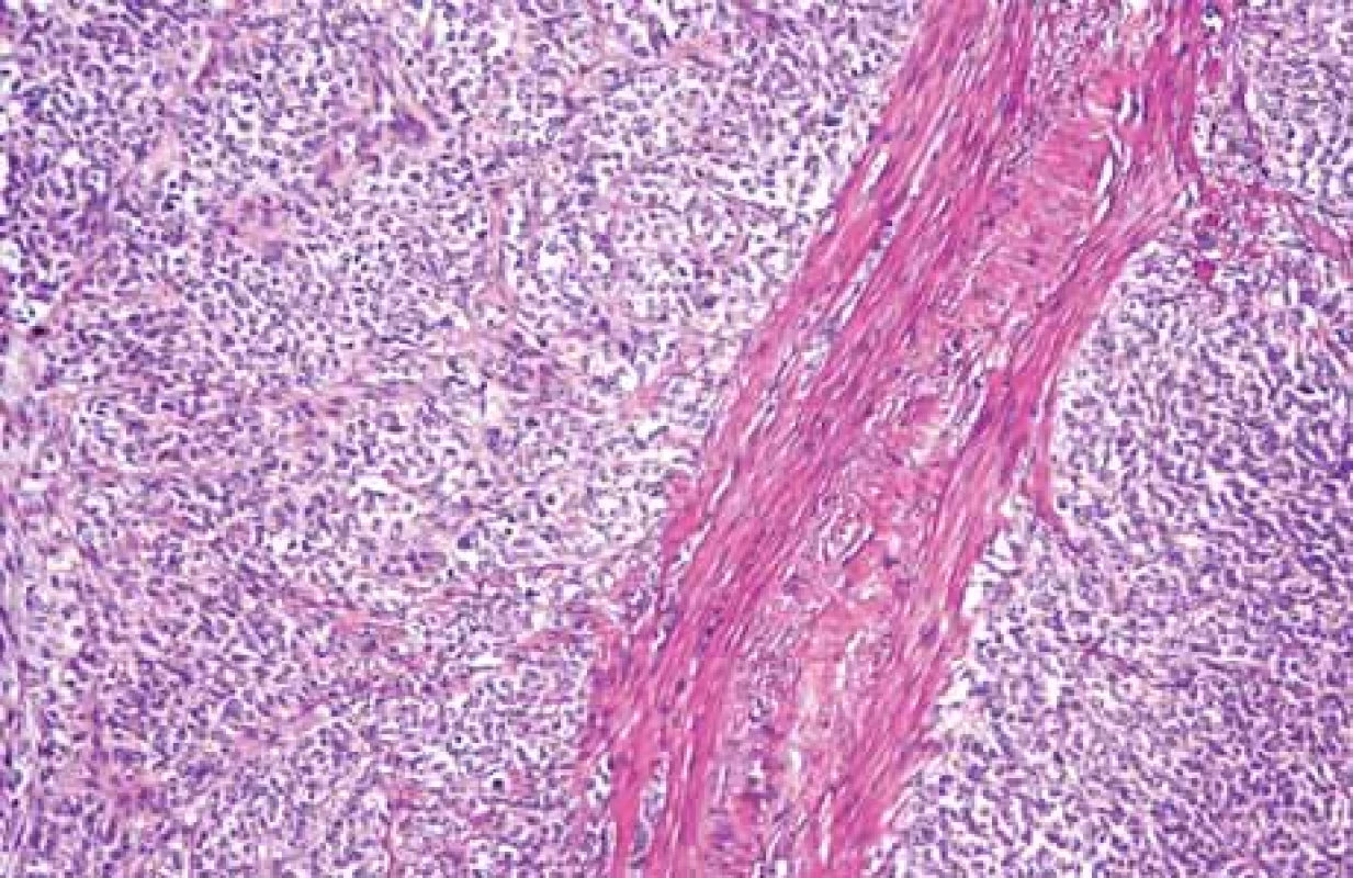 Mikroskopický obraz nádorových buněk, největší část tumoru (plné
šipky) uložena ve svalovině (prázdná šipka), zvětšení 40x (hematoxylin eosin).<br>
Fig. 4. Microscopic image of tumor cells, the largest of the tumor (solid arrows)
deposited in the muscle (empty arrow), magnifi cation 40x ( hematoxylin eosin).