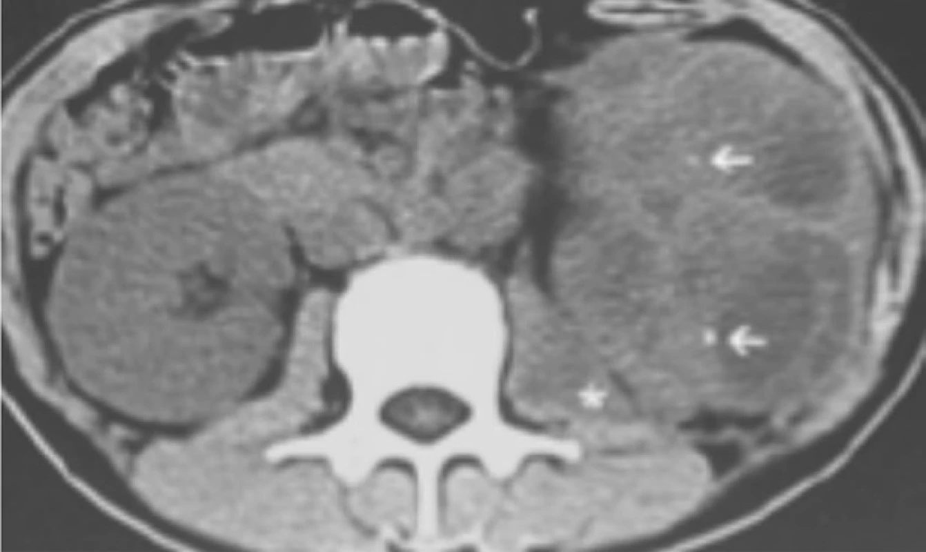 CT vyšetření: na transverzálním
řezu jsou patrné mnohočetné
kaverny levé ledviny<br>
Fig. 2. CT scan: transverse section
with multiple caverns in the
left kidney