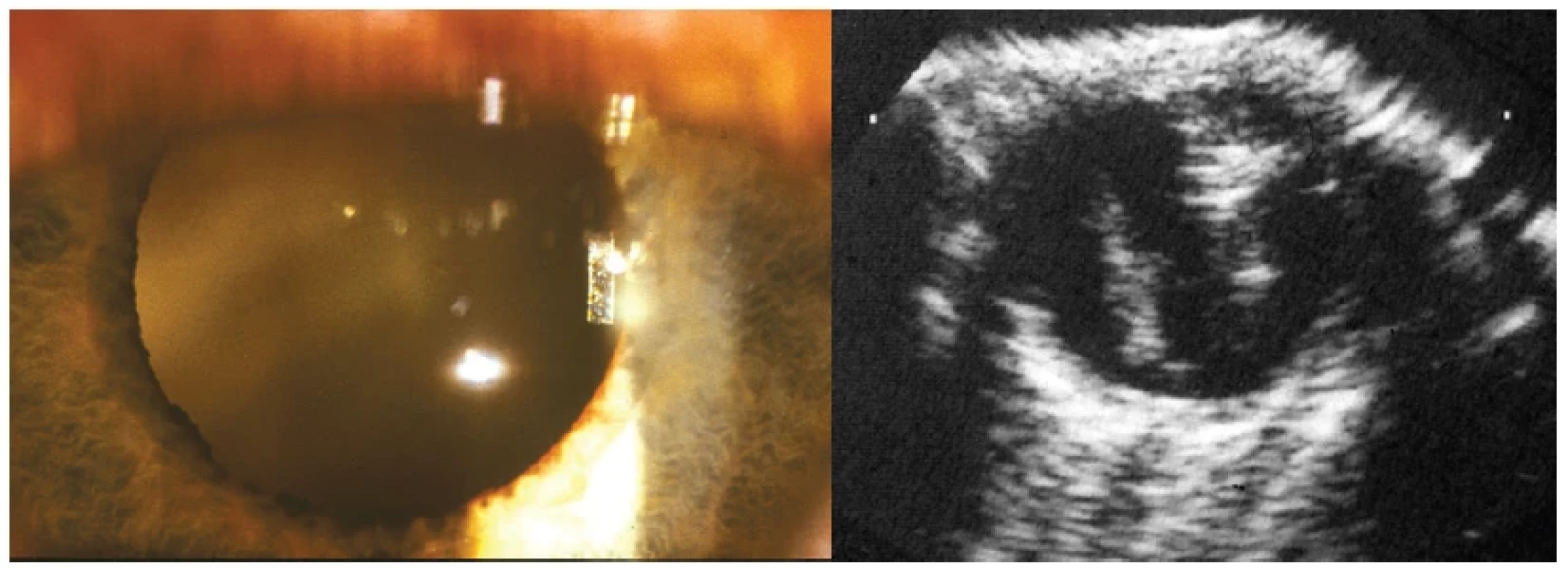 Vlevo: Zkalení sklivce toxokarové etiologie patrné retrolentálně
Vpravo: Ultrazvukový obraz toxokarové endoftalmitidy se zánětlivými konglomeráty sklivce a trakčním pruhem jdoucí od papily
do periferie sítnice