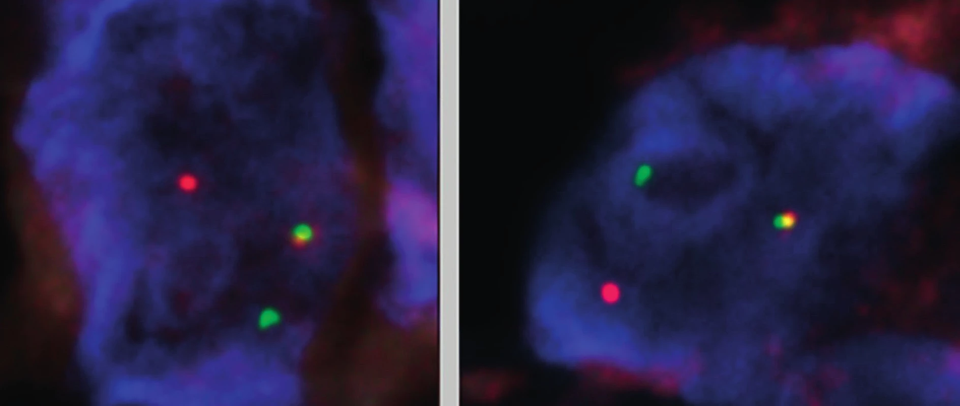 Metoda FISH – mikrofotografie dvou jader buněk se zlomem v oblasti genu USP6 (17p13.2). (V každém z jader buněk jsou přítomné dva chromozomy 17; jeden chromozom 17 se zlomem v oblasti genu USP6 – oddálené zelené a červené signály, druhý chromozom 17 s intaktní oblastí 17p13.2 – zeleno-žluto-červený signál). Fluorescenční in situ hybridizace na jádrech v interfázi, histologický řez z formolem fixované a do parafinu zalité tkáně; sonda umožňující detekci zlomu v oblasti 17p13.2 (oblast za místem zlomu směrem 
 k centromeře chromozomu 17 je značena fluorochromem poskytujícím červenou fluorescenci, oblast za místem zlomu směrem k telomeře chromozomu 17 je značena fluorochromem poskytujícím zelenou fluorescenci, jádra zvýrazněna fluorochromem poskytujícím modrou fluorescenci).