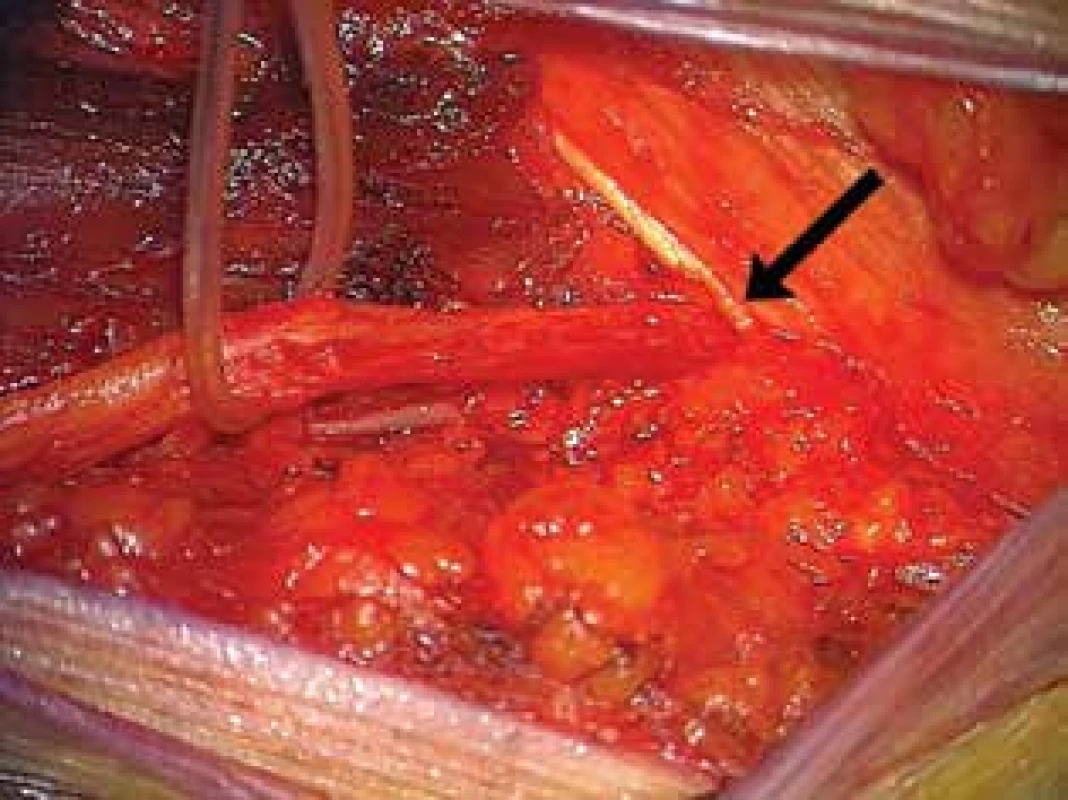Komprese n. cutaneus femoris lateralis pod lig.
inguinale vlevo (šipka)<br>
Fig. 4: Compression of the lateral femoral cutaneous
nerve under the inguinal ligament on the left side
(arrow)