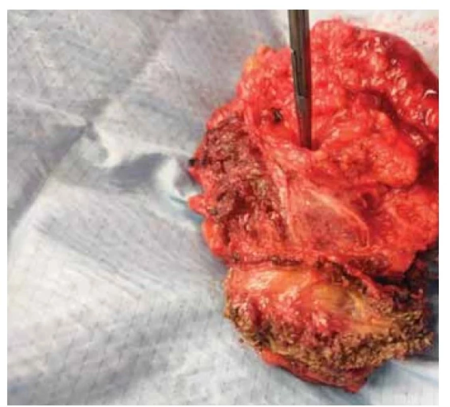 Recidiva karcinomu endometria v břišní stěně po
kompletní excizi.<br>
Fig. 1. Recurrence of endometrial carcinoma in the abdominal
wall after complete excision.