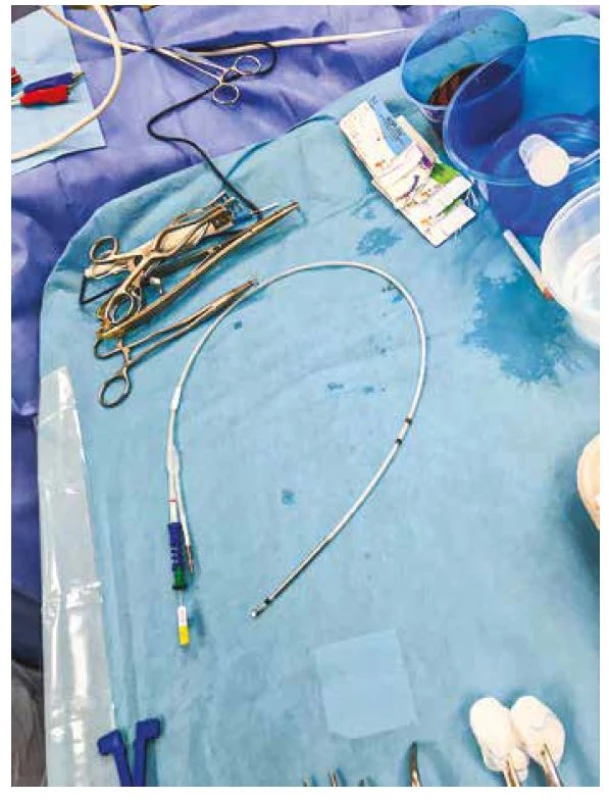 Defibrilační komorová elektroda k jednodutinovému ICD, schopná
snímání signálu i z pravé síně díky ringu v proximální části elektrody