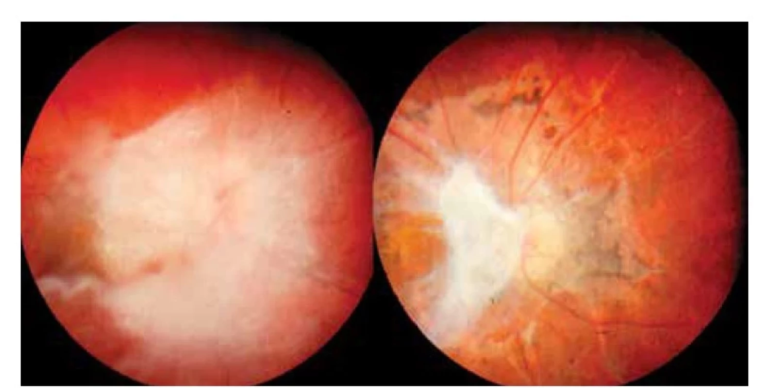Obraz toxokarové neuropatie s vitritreální reakcí v okolí před celkovou
terapií<br>
Vpravo: Výrazné jizevnaté sítnicové změny s atrofií papily zrakového nervu a zbytky vitreální
membrány po kombinované léčbě o rok později