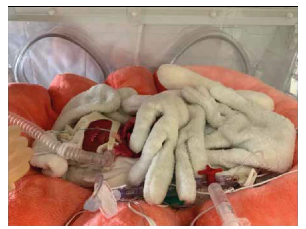 Extrémně nedonošený novorozenec na jednotce intenzivní a resuscitační péče, dva dny po
porodu. Porodní váha 520 gramů, narozený ve 24. gestačním týdnu. [Foto: archiv autora]