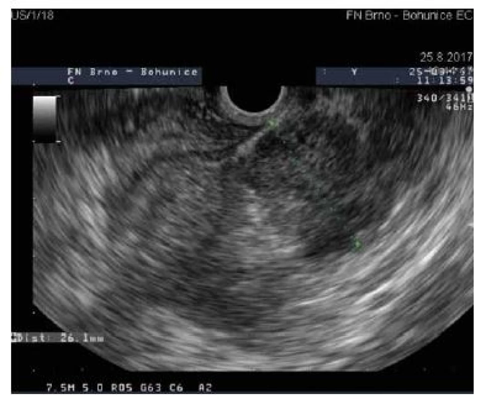 Linear EUS image of an ovoid solid hypoechogenic mass in the pancreatic head, size 26 mm.<br>Obr. 2. Oválné hypoechogenní solidní ložisko v hlavě pankreatu o průměru 26 mm.