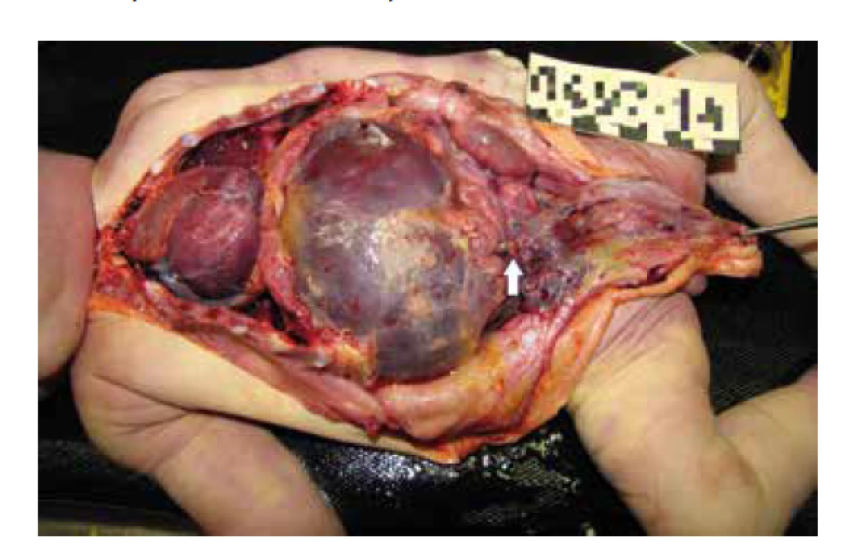 Obnažená brušná dutina so splývavými zrastmi peritonea s tumoriformným
útvarom v oblasti ilea (šípka).