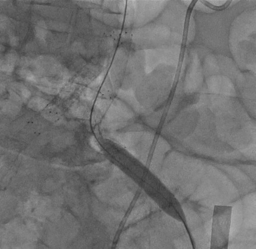 Stentgraft a. iliaca communis sinistra<br>
Fig. 3. Left common iliac artery stent graft