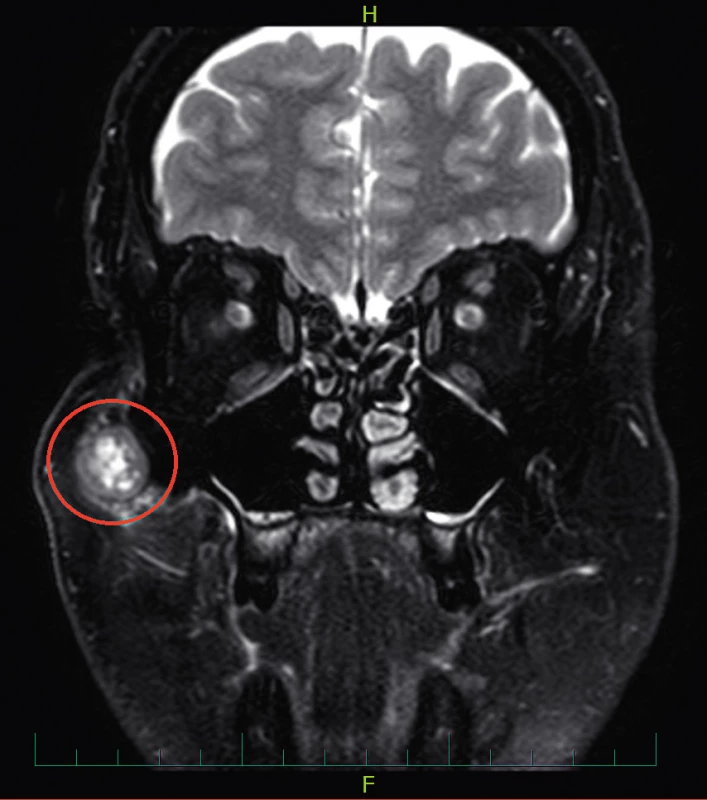 Nodulární fasciitida (vyznačena červeně) na MRI hlavy v T2 váženém obraze, koronární projekce