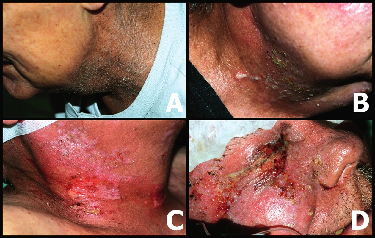 Stupně dermatitidy podle klasifikace RTOG <br>
A – dermatitida 1. stupně – suchá deskvamace, B – dermatitida 2. stupně – vlhká deskvamace, C, D – dermatitida 3.–4. stupně  (fotoarchiv autorky)
