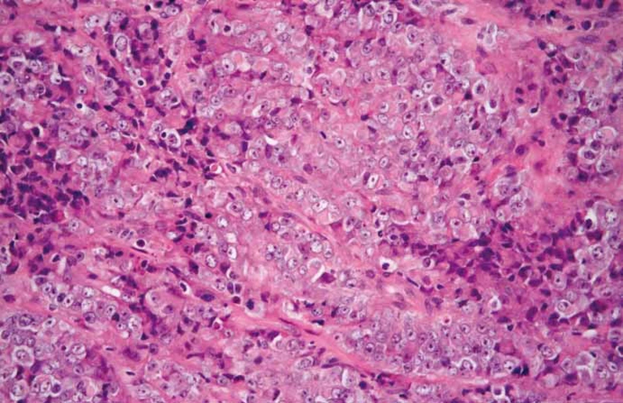 Malobuněčný karcinom hyperkalcemického typu. Nádor sestává z objemných
buněk s vezikulárními jádry s dobře patrnými jadérky a s bohatou eozinofilní cytoplazmou.
Jedná se o tzv. velkobuněčnou, příp. rhabdoidní variantu tohoto nádoru (hematoxylin-eozin, původní zvětšení 400×).