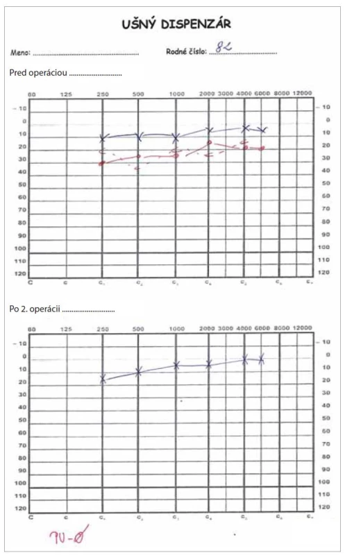 Audiometrické vyšetrenie pacientky – ľahká percepčná porucha sluchu
vpravo.<br>
Fig. 3. Audiometric examination – mild perceptual hearing loss on the right.
